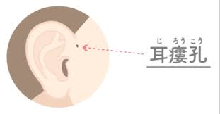 耳瘻孔イラスト図